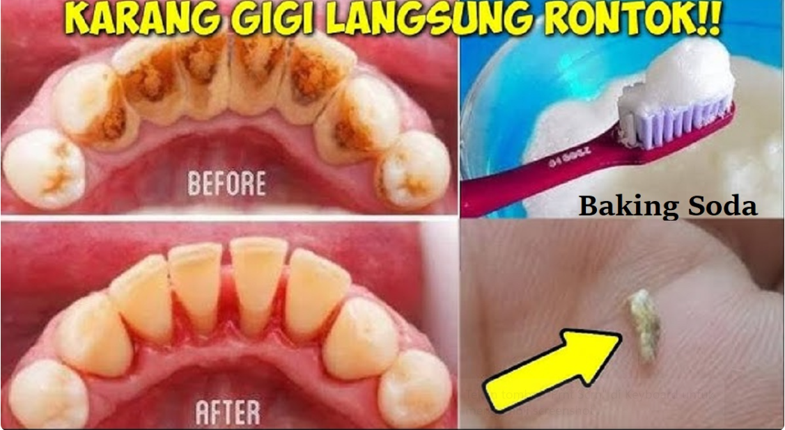 5 Cara Merontokan Karang Gigi Membandel yang Efektif